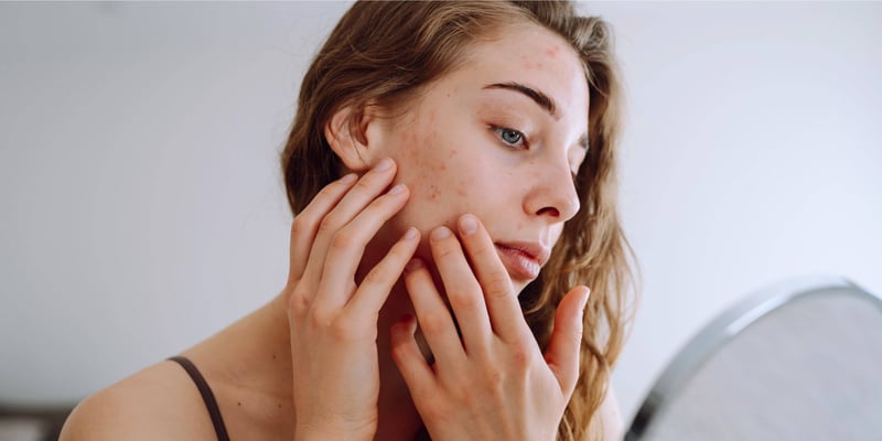 Lady looking at her acne on the mirror