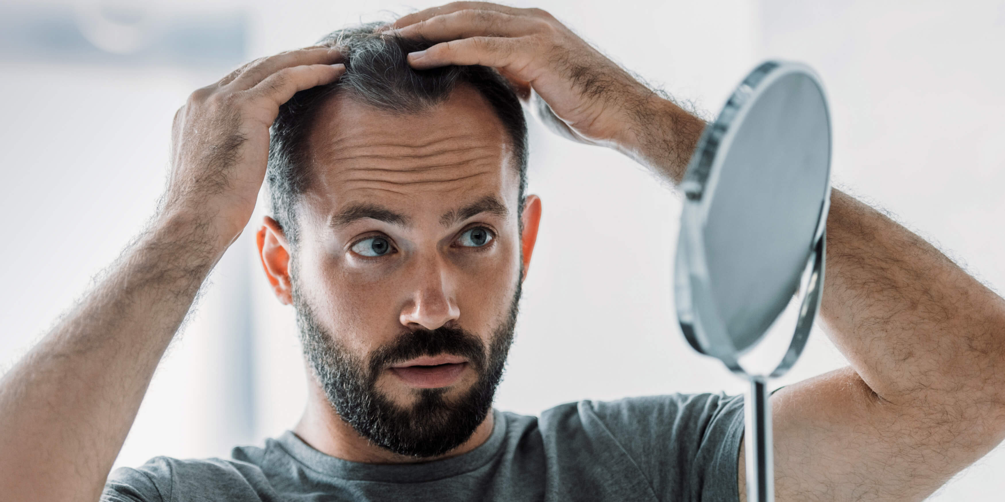 Receding Hairline Causes treatments and prevention